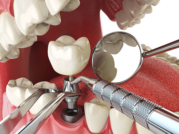 Best Emergency Root Canal Treatment in Sedalia, MO